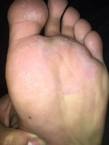 最近发现脚底成这样了,这是什么情况?