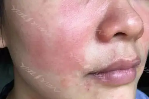 当皮肤屏障受损会出现什么症状