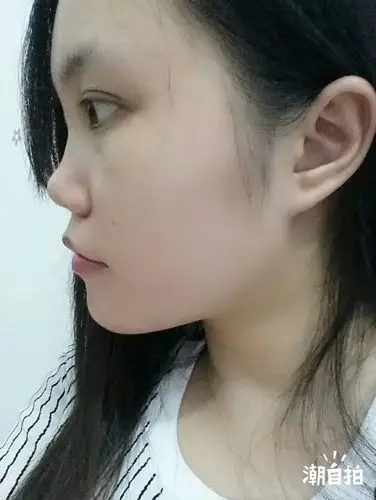 我的鼻子很塌,下巴也很突出,如果整容怎么整比较好,安全点的,侧脸好