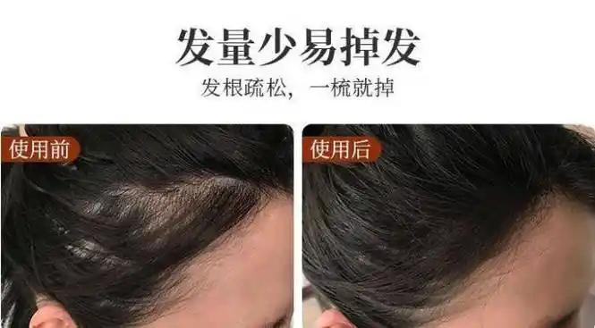 防脱洗发水哪个品牌的口碑好唯一有效的防脱控油去屑洗发水