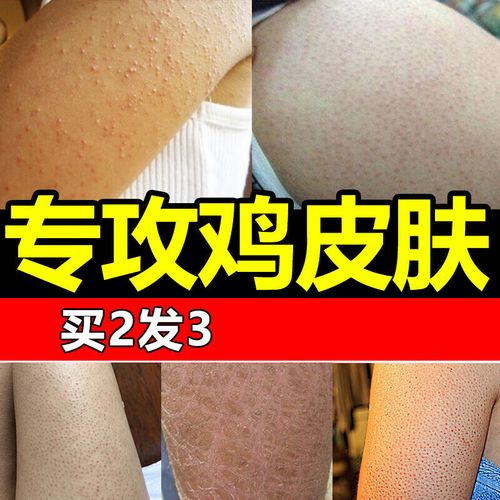 nhfouyou毛周角化症肤疙瘩毛囊炎手臂腿部痘痘毛孔堵塞疏通专用 塞 塞