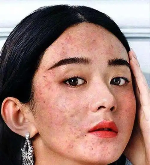 杨幂赵丽颖满脸痘痘,迪巴关晓彤有红斑,微商炒作这样做好吗?