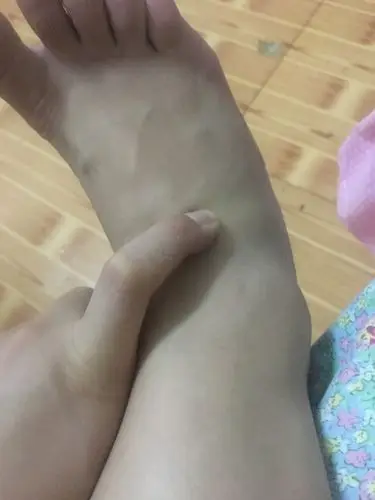 穿高跟鞋走下坡崴脚了,往左前方扑的,已经第12天了手指的地方还是痛