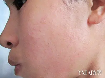 【图】脸上过敏长红疹图片介绍 5大步骤轻松还原健康皮肤