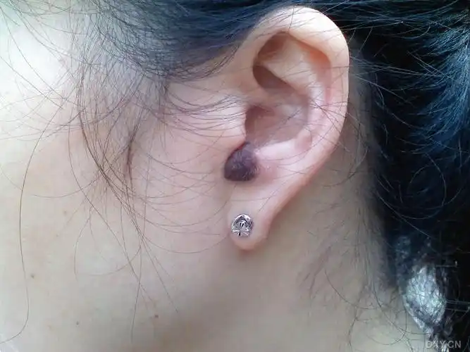 【讨论】耳郭色素痣 [病例帖]