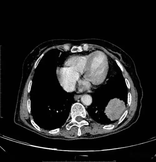 胸部ct平扫示左下肺占位肺癌