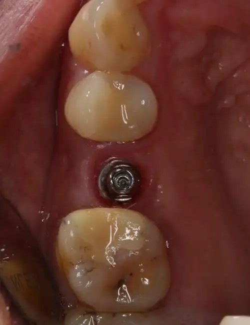 您的种植牙上洞吗