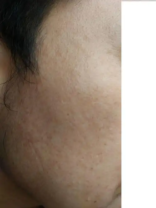 皮肤粗糙 毛孔粗大 暗黄 腮帮子处是红色的斑点还是红色的痘子 这样的