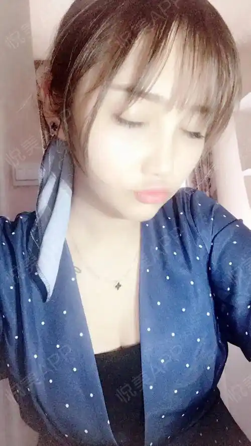 假体隆胸术后14天_隆胸术后14天_胸部整形术后14天_颜值精选术后14天