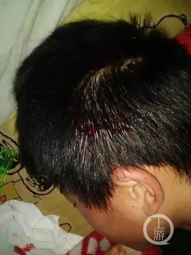 初中生放学路上被同校学生家长驾车追打:伤势严重昏迷10小时,打人者已