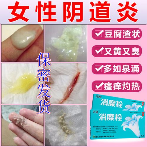 治多种妇科炎症霉菌性阴炎内用药妇科外阴瘙痒专用宫颈糜烂妇科用药二