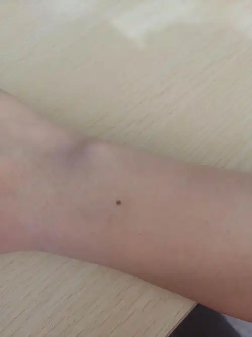 两手腕背部长了对称痣是什么意思,位置颜色大小基本一样