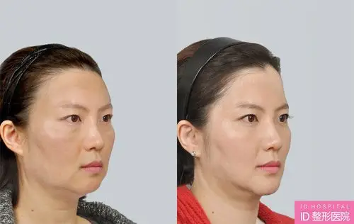 韩国整形医院脂肪填充前后对比照片