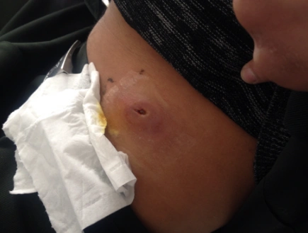 臀部火疖子图片4