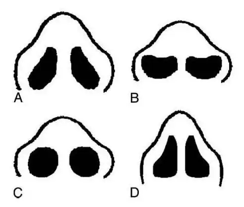 鼻孔不对称应该怎么办?