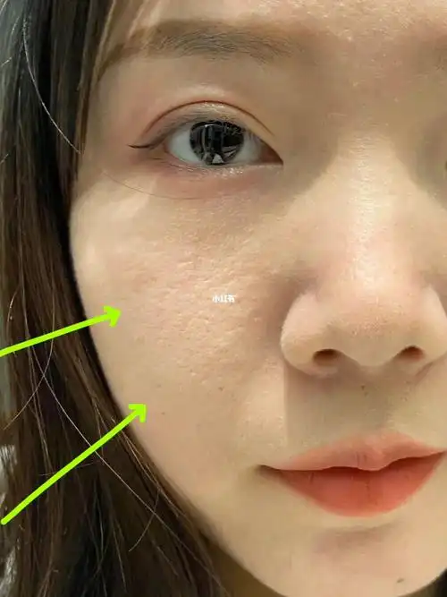 摊牌了!毛孔粗大成功下车!