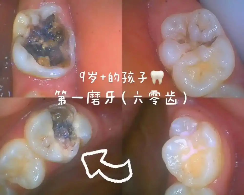 9岁半孩子的第一磨牙(六零牙)即6到7岁新长出来的07牙!你 - 抖音