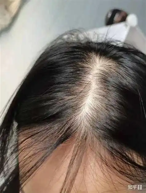 女性头顶掉发