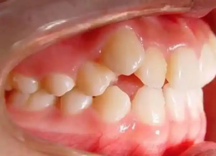 虎牙出现主要是尖牙的位置不足而引起的,一般由于尖牙的萌出时间比它