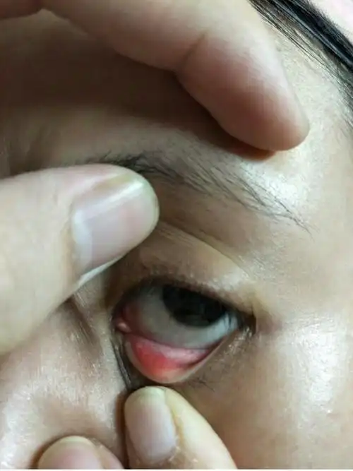 眼睛里面长了个小白点