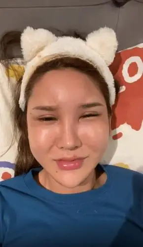 女网红出现整容后遗症,脸肿成馒头眼睛睁不开,崩溃痛哭称自己要去住院
