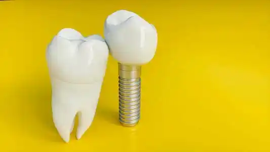 种植牙齿图片-种植牙齿素材-种植牙齿插画-摄图新视界