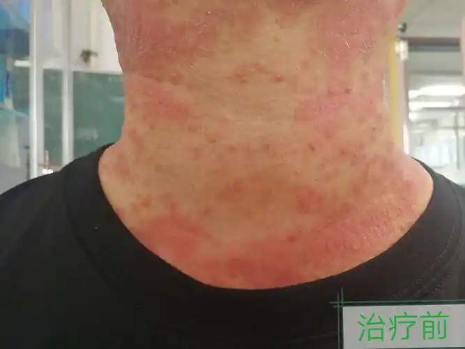 多形性日光疹1例