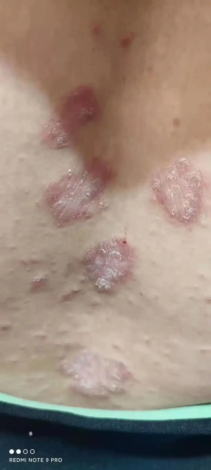 毛囊炎 5hot on mi6x mi dual camer - 抖音