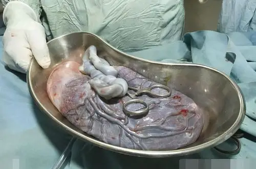 被中国婆婆捧上天的胎盘恐怕没你想象的那么神奇还是不要的好