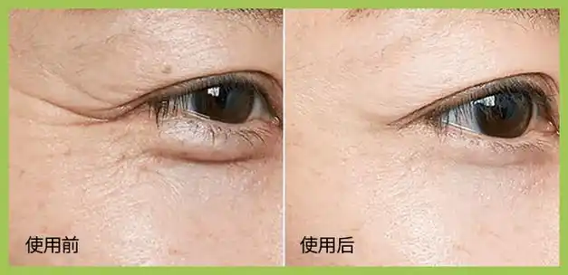 用它敷眼视力好了眼纹眼袋消了眼睛年轻20岁