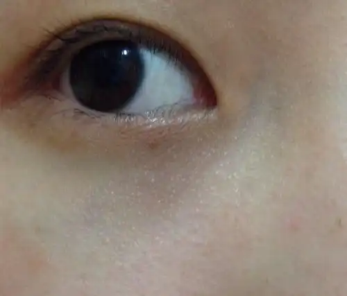 眼角下面的小颗粒是脂肪粒吗?怎么除去啊?