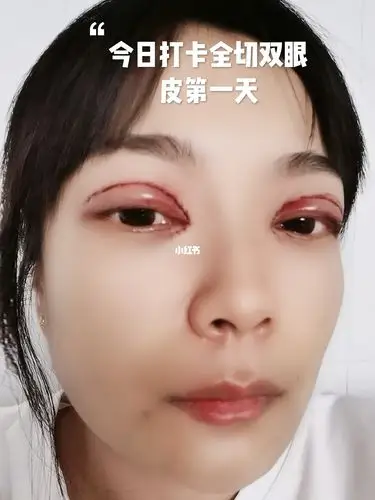 全切开眼角双眼皮第一天