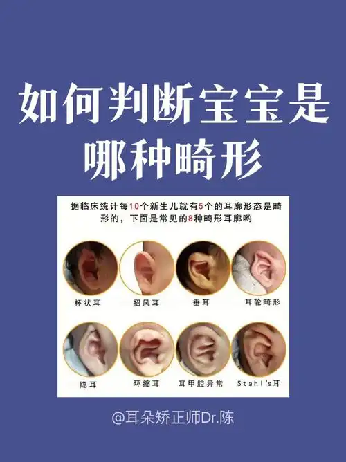 在临床上一般有8种耳廓畸形,如果宝妈觉得自己宝宝耳朵不那么好看