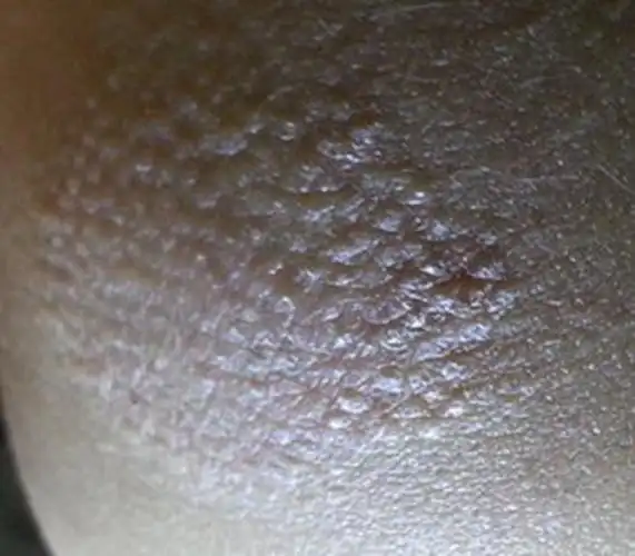 孕妇疥疮初期腹部皮肤症状图片