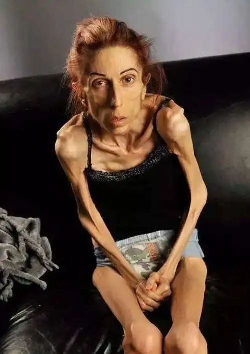 世界上最瘦的人,从开朗自信到堪称行走的骷髅