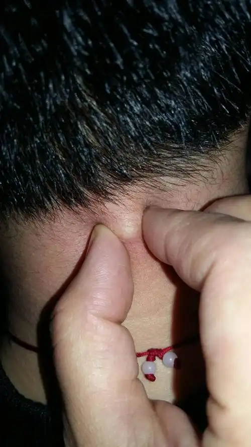 个粉刺,后来逐渐变硬了,也不疼不痒,就是摸着有黄豆粒这么大的硬疙瘩