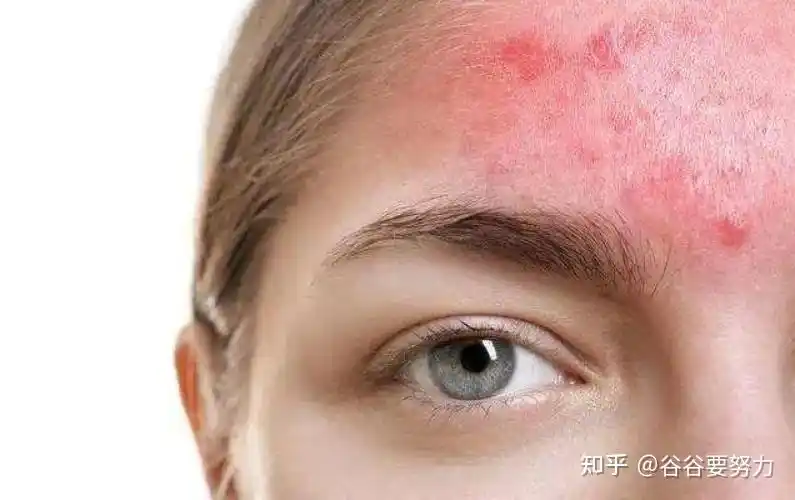 到底什么是皮肤屏障受损很多人理解错了难怪皮肤越来越差