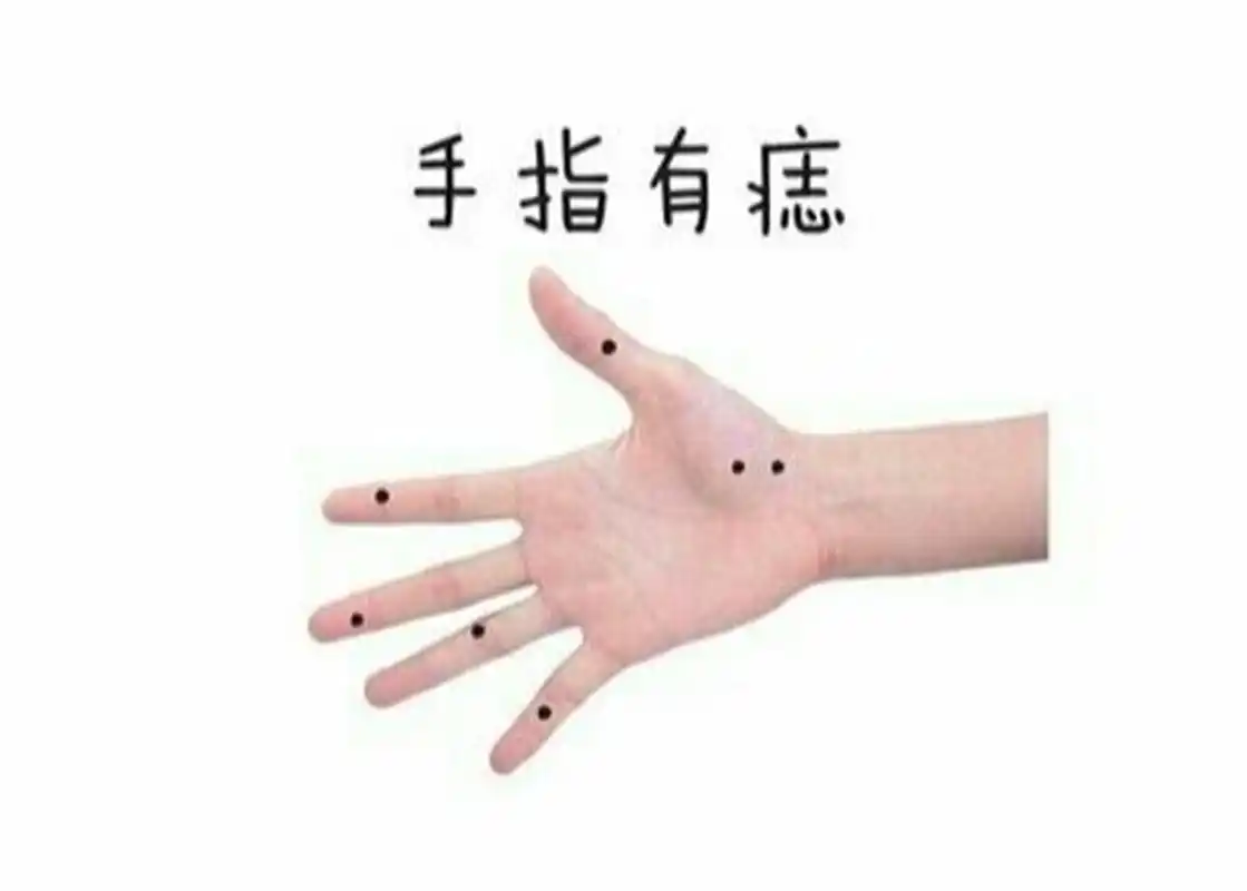 94a,大拇指有痣: 在面像学中如果大拇指或者是其附近有痣,这表示