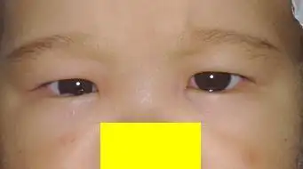 50d的内斜视患儿都予以矫正. 2.     治疗 弱视 ; 3.