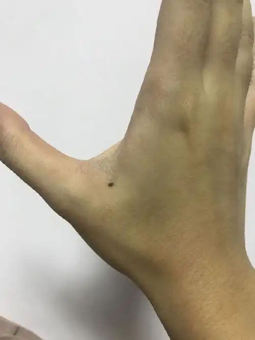 大拇指与食指连接处就叫虎口,一般这里这里长痣的人,绝大多数都是表里