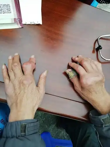 痛风对手指关节的损坏