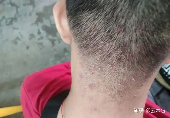 头皮毛囊炎怎么治?亲身治疗经验总结 - 知乎