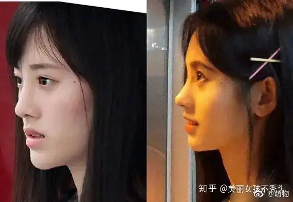 你觉得鞠婧祎整容了吗?(原提问貌似引战,原提问者见问题日志)?