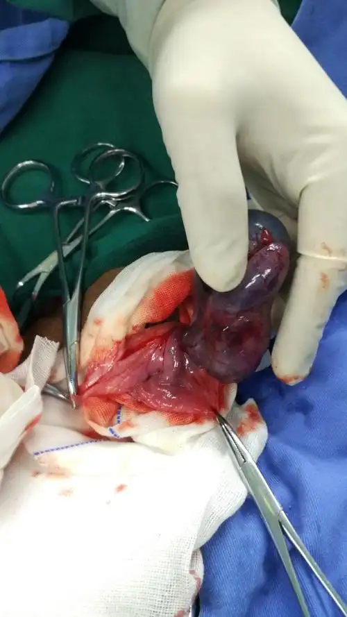 又一例睾丸扭转切除_阴囊