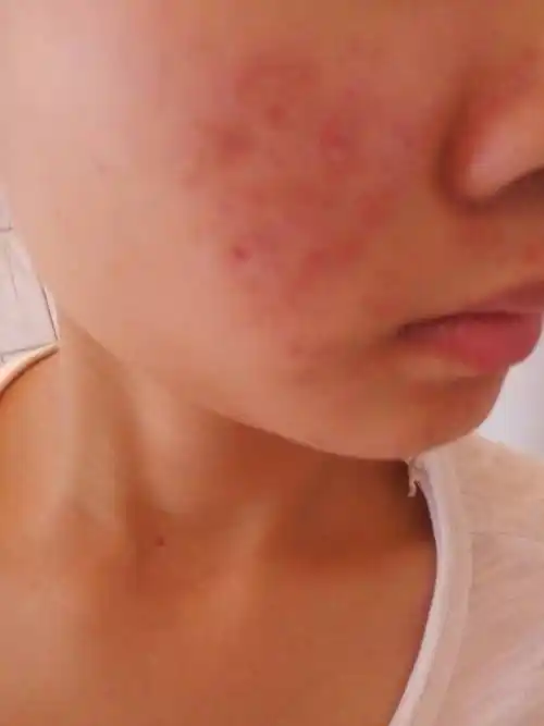 这是毛囊炎还是痤疮!要用什么治疗!我就t区毛孔粗大!其它地方都没长!