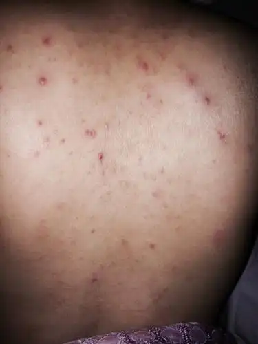 一大片,但不密集,里面有脓! 此起彼伏! 医生说是热毒