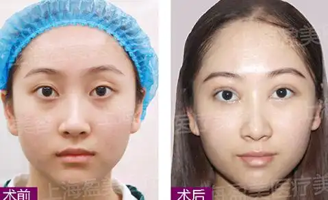 双眼皮修复 内眼角 上眼睑脂肪填充真人案例-杨璐主治医师-爱问医生