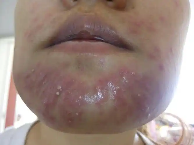 下巴和嘴鼻周围长了痤疮 红的白的还连成一片 痒刺痛 下巴肿的很沉