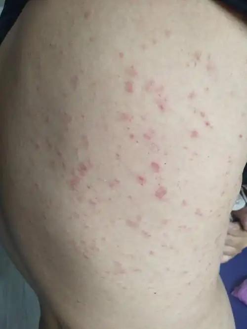 问:一晚上就起了很多很痒的红疙瘩不是蚊虫叮咬的是什么原因