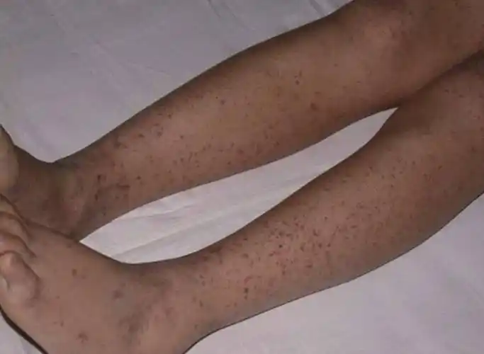 身上出现小红点不痛不痒别不当回事贤医健康说